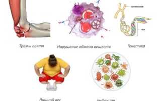 Деформирующий остеоартроз локтевого сустава