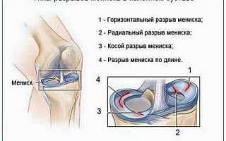 Что такое мениск колена