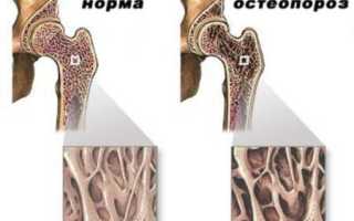 Симптомы остеопороза тазобедренного сустава