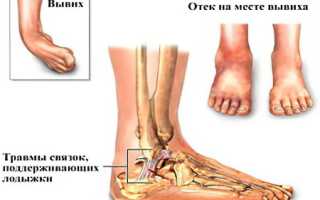 Вывих ноги чем лечить
