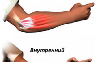 Лечение эпикондилита локтевого сустава