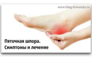 Шпора на ноге что это такое