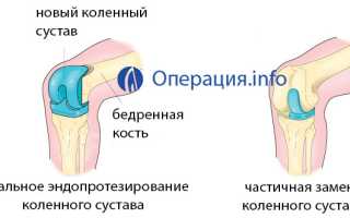Эндопротезирование колена