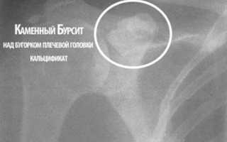Бурсит плечевого сустава симптомы