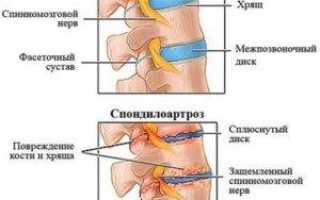 Признаки спондилоартроза поясничного отдела