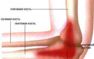 Боль в локте левой руки причины