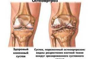 Заболевание суставов ног