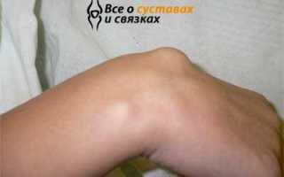 Гигрома что это такое