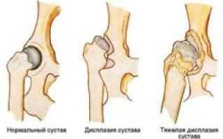 Связки тазобедренного сустава