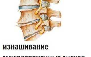 Что такое остеофиты на позвоночнике