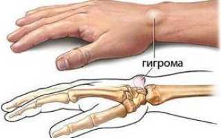 Что такое гигрома
