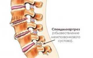 Признаки спондилоартроза поясничного отдела