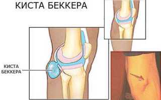 Разрыв кисты беккера