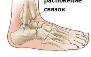 Растяжение связок симптомы