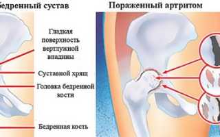 Заболевания тазобедренного сустава симптомы и лечение