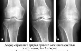 Гонартроз коленного сустава 3 степени инвалидность