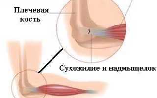 Чем лечить эпикондилит