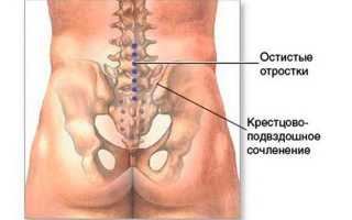 Крестцово подвздошное сочленение лечение