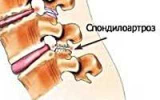 Что такое спондилоартроз поясничного отдела позвоночника