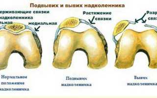 Симптомы травмы мениска коленного сустава