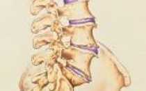 Остеоартроз позвоночника