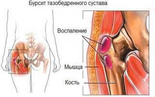 Как избавиться от боли в тазобедренном суставе