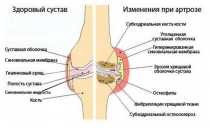 Лечение коленей