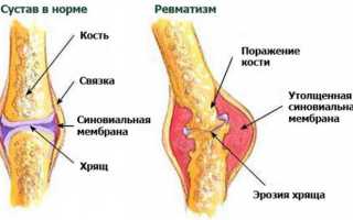 Чем лечить ревматизм ног